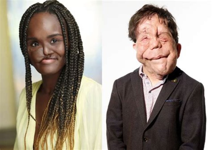 Adam Pearson Age: Unveiling the Journey and Legacy of a Remarkable Figure