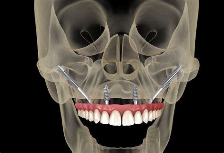 Brilliant Chrome Dental Implants: Long-Lasting Smiles