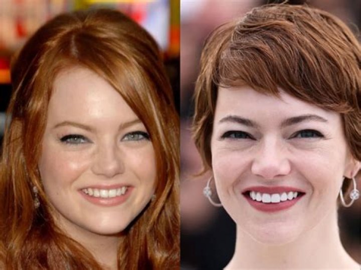 Emma Stone Face Surgery: What You Need to Know
