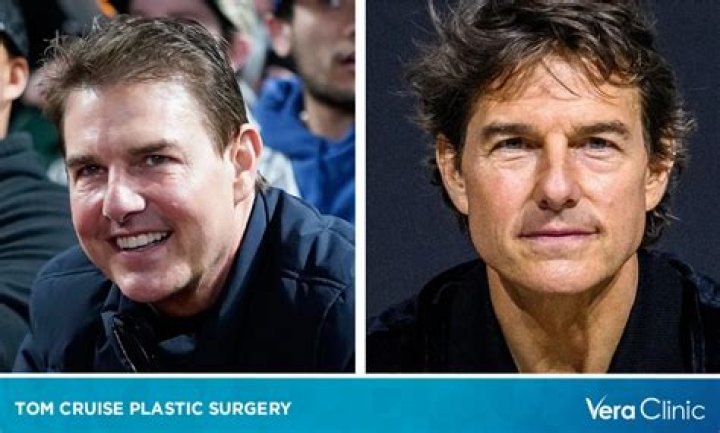 Tom Cruise Plastic Surgery: Unveiling the Truth Behind His Ageless Appearance