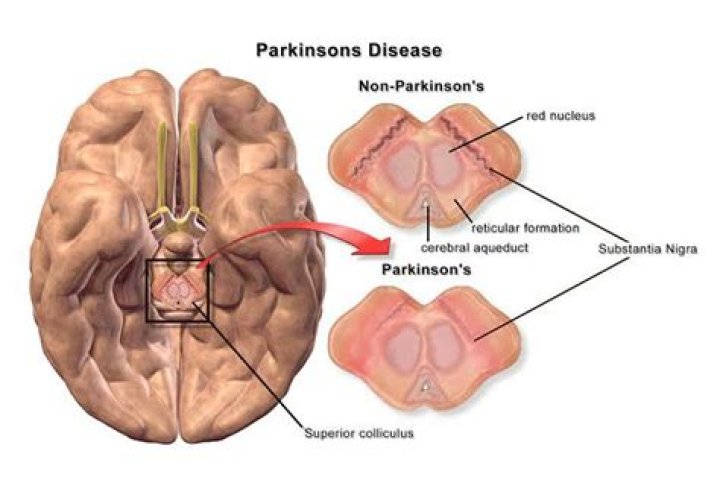 Tom Elleck and Parkinson's Disease: A Comprehensive Guide