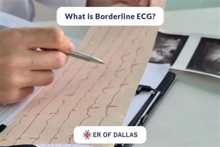 Understanding Borderline ECG: A Comprehensive Guide